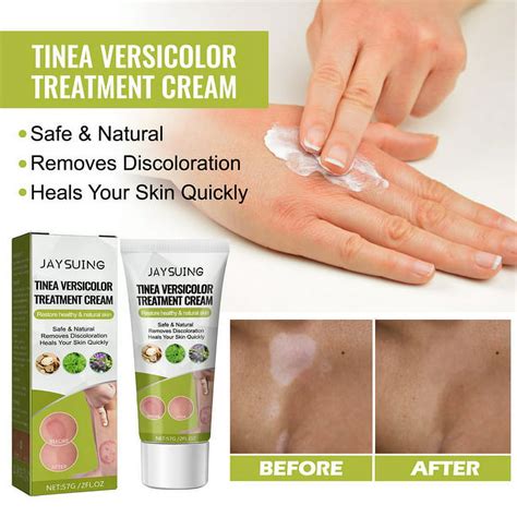 Tinea Versicolor Treatment Cream Antifungal Cream For Tinea Versicolor