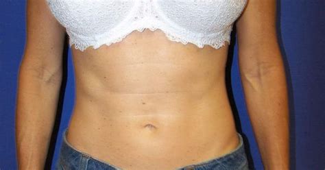 Breast Augmentation Before And After Breast Augmentation Breast