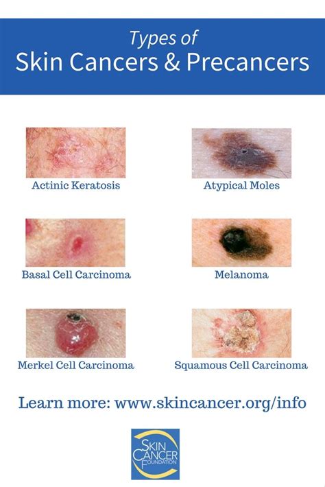 Do You Know All Of The Different Types Of Skin Cancers And Precancers My Xxx Hot Girl