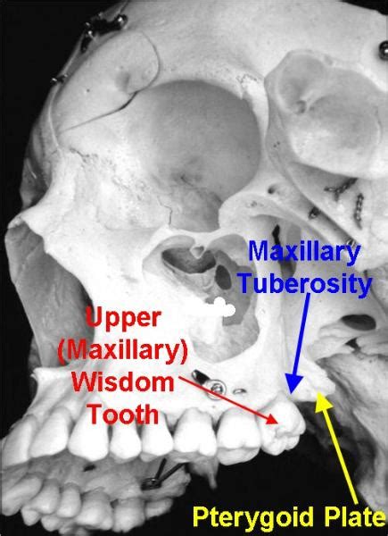 Fractured Maxillary Tuberosity | Dentistry Today