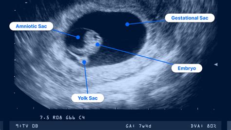 7 Weeks Pregnant Ultrasound Pockethealth