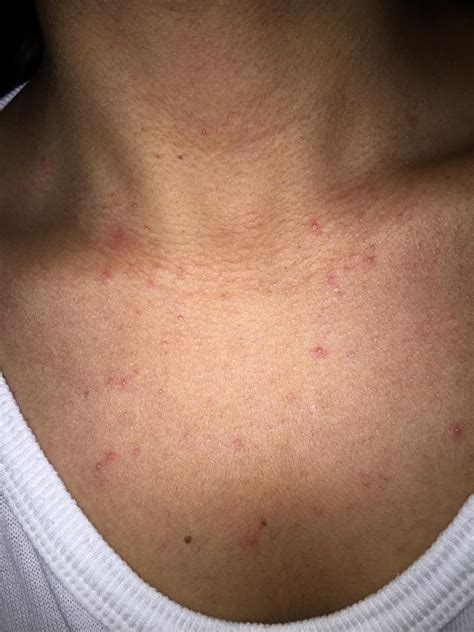 Chest Acne And Back Acne Backbodyneck Acne By Livelife13
