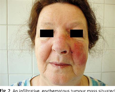 Figure 2 From A Case Of Diffuse Large B Cell Lymphoma Misdiagnosed As