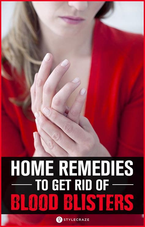 10 Effective Home Remedies To Get Rid Of Blood Blisters Blood Blister