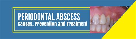 Periodontal Abscess Causes Prevention And Treatment