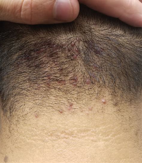 36 Bumps On Back Of Head After Haircut Gyanoghenedoro