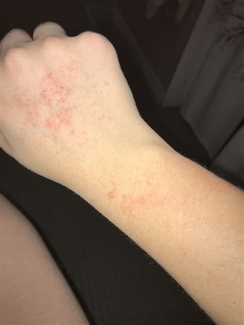 Identifying Skin Rashes On Hands My Xxx Hot Girl