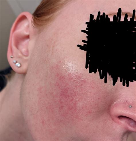 Help With Rosacea Andor Keratosis Pilaris On My Face