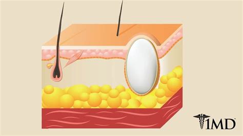 Whats A Sebaceous Cyst Signs Treatments And What To Expect 1md