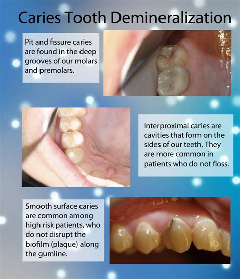 Caries And Tooth Demineralization Mcfarlane Dental