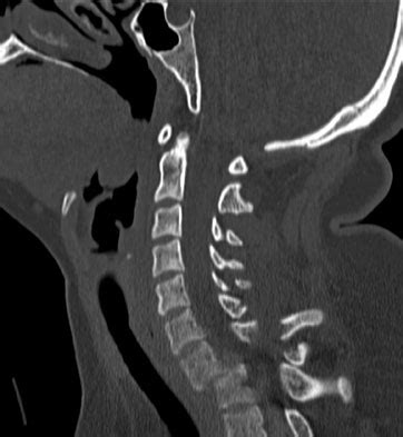 Cervical Facet Dislocations Fractures Spine Orthobullets Hot