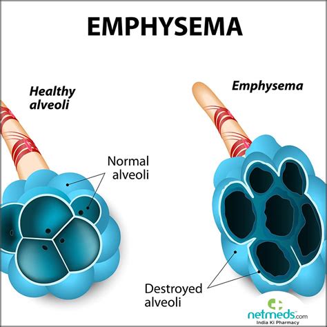 Emphysema Causes Symptoms And Treatment Netmeds