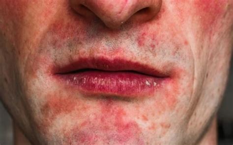 Rashes Around The Mouth Causes And Treatment