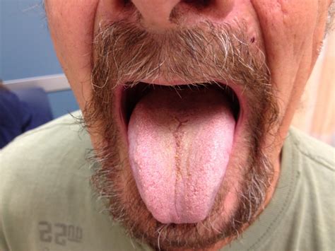 Linezolid Induced Black Hairy Tongue A Case Report Journal Of Medical Case Reports Full Text