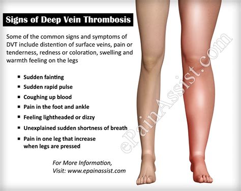 Warning Signs Of Deep Vein Thrombosis How Do I Know If I Have DVT
