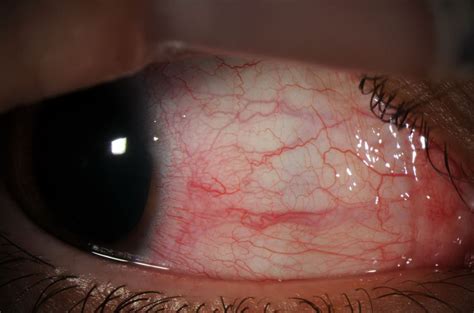 Moran Core Episcleritis Associated With Lyme Disease