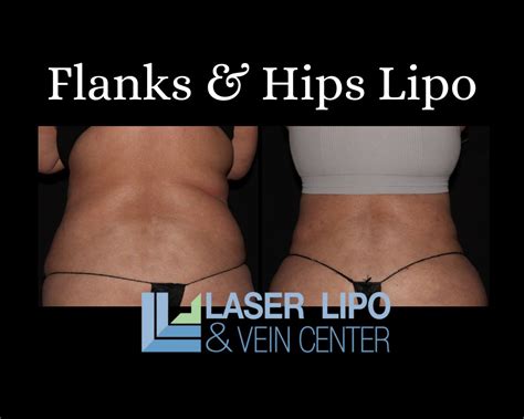St Louis Flank And Hip Liposuction Procedure Laser Lipo And Vein Center