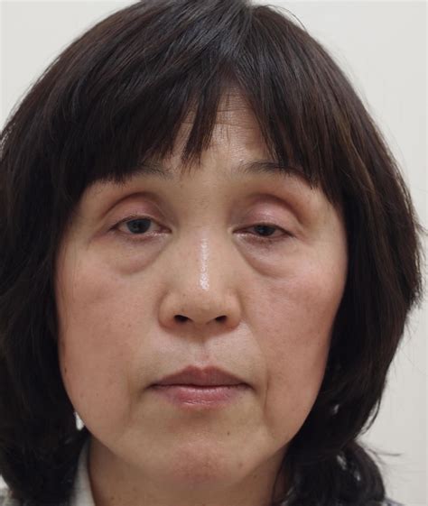 目のクマ・たるみ治療の症例写真 セオリークリニック 東京・銀座の美容整形外科