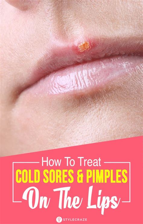 How To Treat Pimples On The Lips