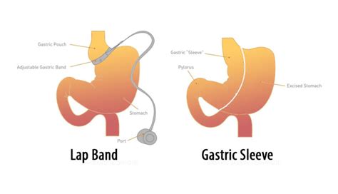 Gastric Band To Sleeve Gastrectomy Dr Mario Camelo