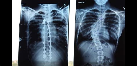 Before And After Photos Of My Spinal Surgery Rscoliosis