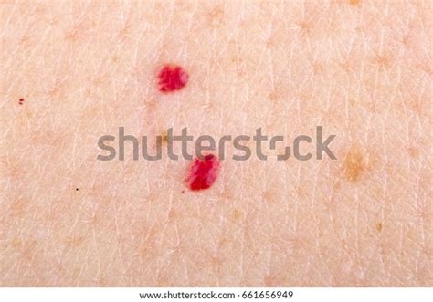 Close Photo Cherry Angioma On Human Stock Photo Edit Now 661656949