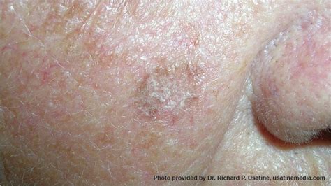 Skin Cancer On Face Early Signs