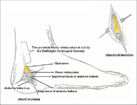 Medial Aspect Of The Ankle Incision For Tarsal Tunnel Release