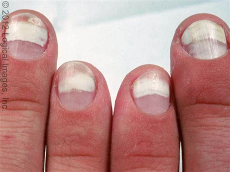 Leukonychia Vs Terry S Nails Nail Ftempo