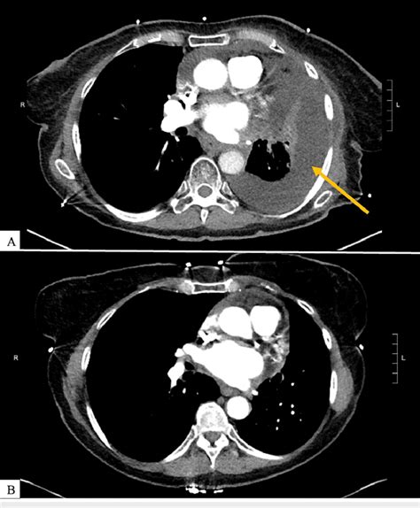 Ct Pulmonary Angiogram At The Time Of Hospital Presentation A