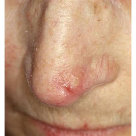Pdf Reconstruction Of Nasal Skin Cancer Defects With Local Flaps
