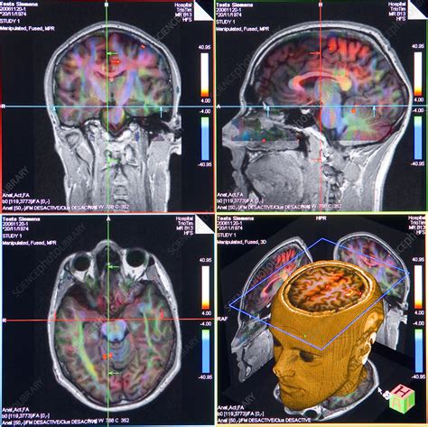 Advanced Mri Brain Scans Stock Image P Science Photo Library