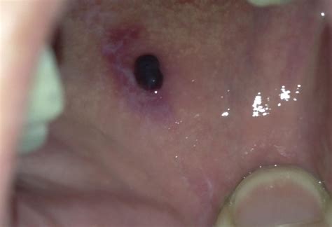 Roof Of Mouth Blister Treatment 12300 About Roof