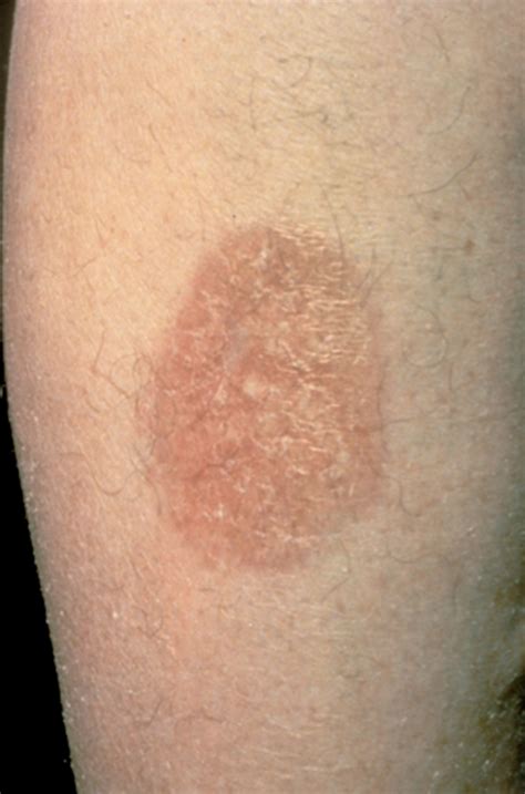 Diabetic Skin Conditions Pictures Photos