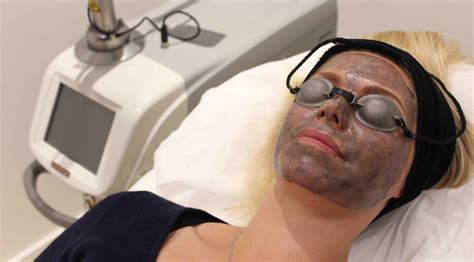 Aesthetic Medicine Lutronic Lasers Presentnew Carbon Spectra Peel