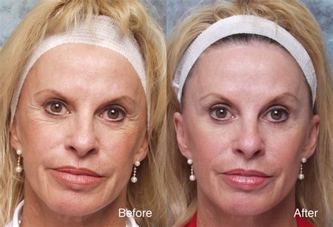 Botox Before After Aglow Vrogue Co