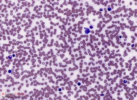 Multiple Myeloma Learnhaem Haematology Made Simple