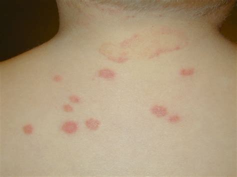 Ringworm In Children Pictures Photos