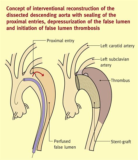 Acute Aortic Syndromes Medicine