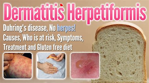 Dermatitis Herpetiformis Causes Symptoms Treatment And Gluten Free