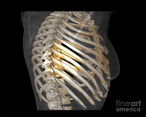 Rib Fractures Photograph By Zephyrscience Photo Library Fine Art America