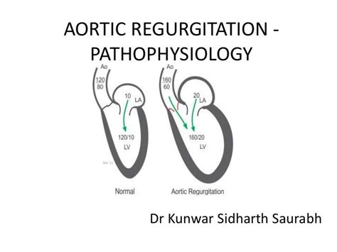 Aortic Regurgitation Pathophysiology