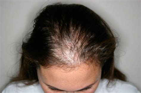 Alopecia In Women Symptoms Causes And Other Risk Factors