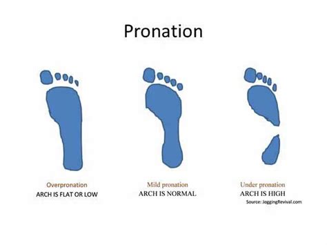 Overpronation Causes Treatment And Exercises Vlrengbr