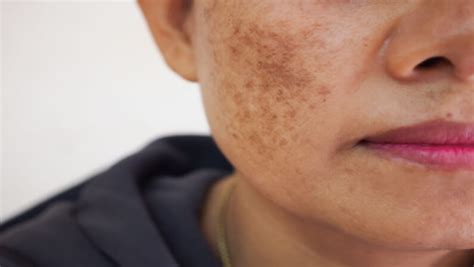 What Are Dark Spots On Skin And How Can You Treat Them Skin Cancer Specialists