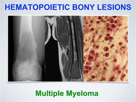 Musculoskeletal Tumors Ppt