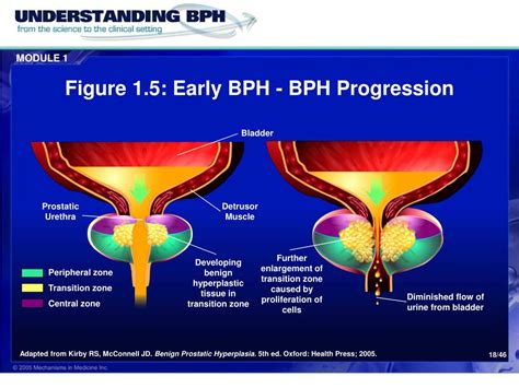 Ppt Module Bph The Disease Powerpoint Presentation Free Download Id
