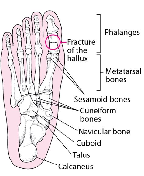 Backbone.js models are also the most important building blocks when it comes to building backbone.js applications. Foot Fractures - Injuries and Poisoning - MSD Manual Consumer Version