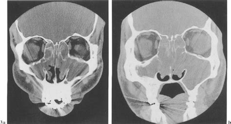 Coronal Ct Of The Paranasal Sinuses Before And After Functional