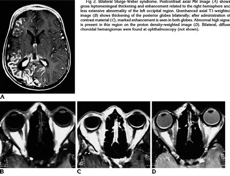 Bilateral Sturge Weber Syndrome Postcontrast Axial Mr Image A